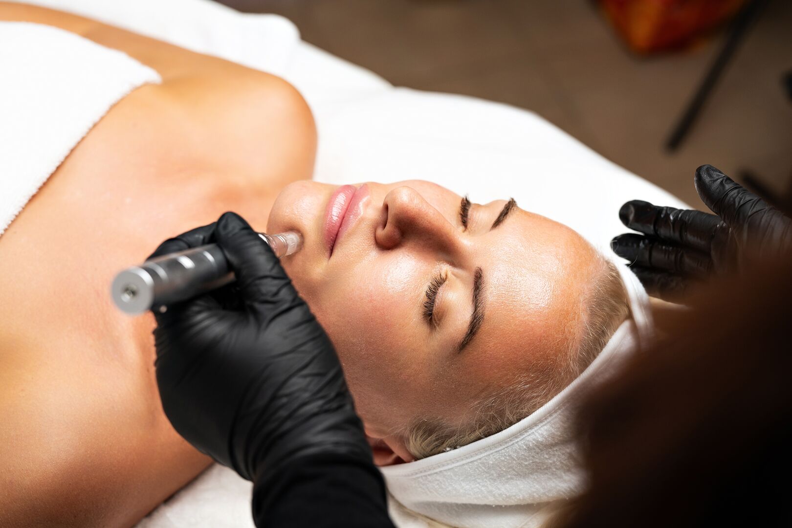 Microneedling